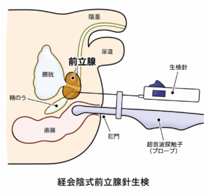 経会陰式前立腺針生検